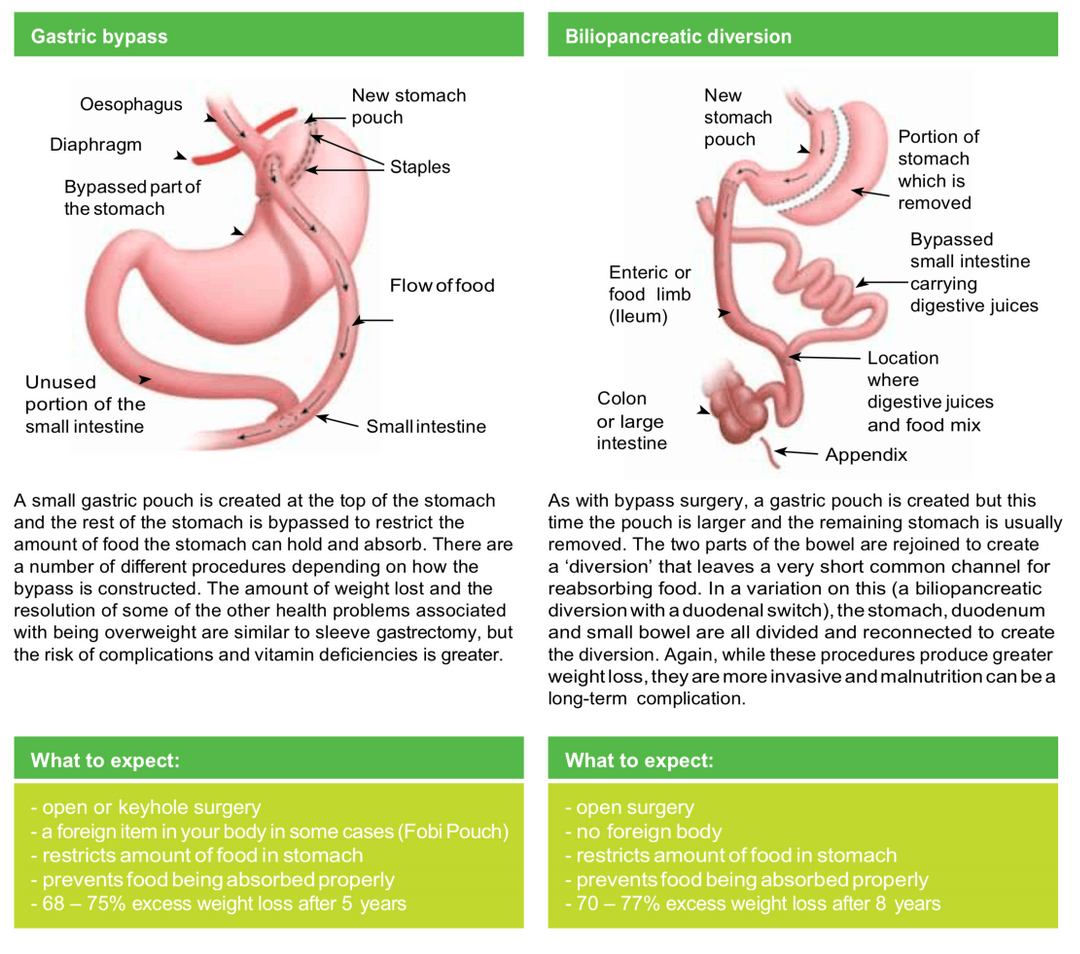 Surgical Options for Gastric Sleeve Procedures